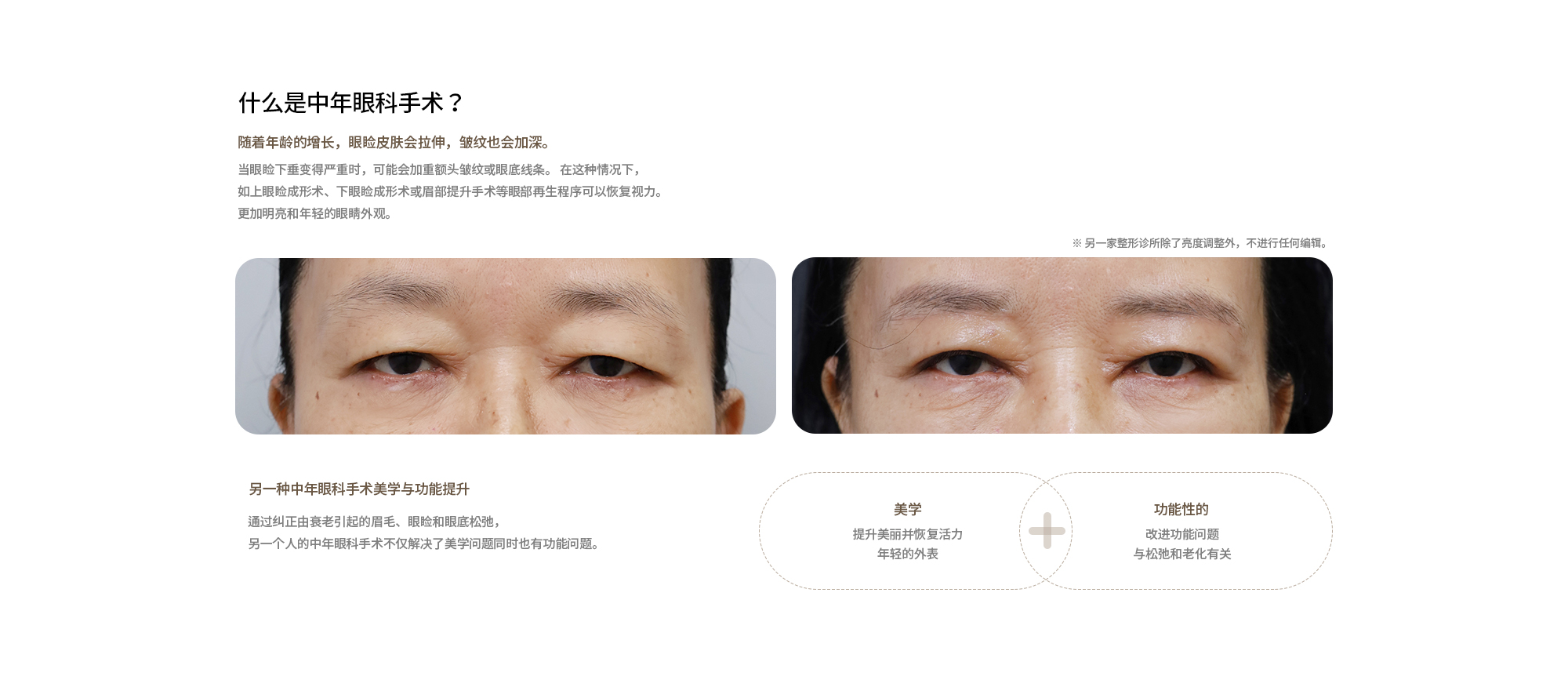 中年眼整形